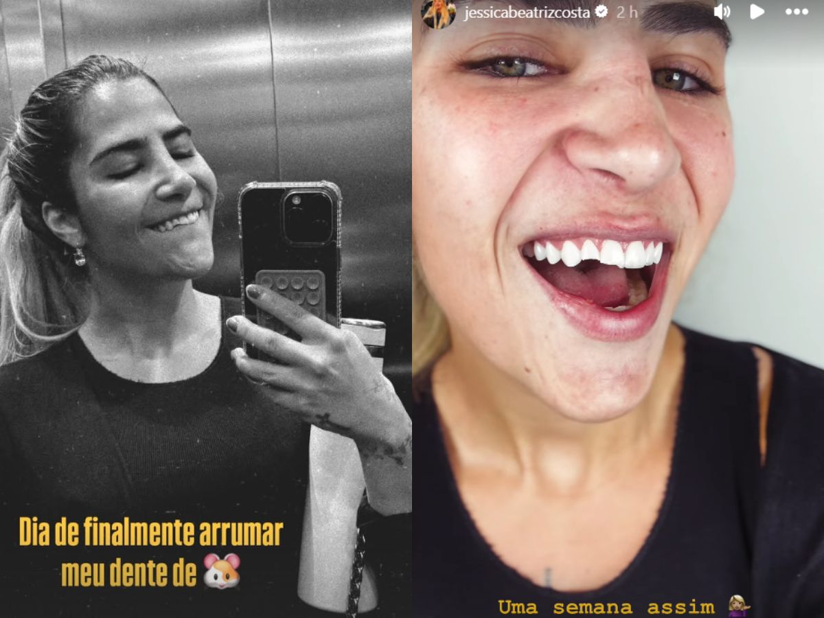 Jéssica Beatriz Costa, filha de Leonardo, exibe reparo em dente após acidente doméstico