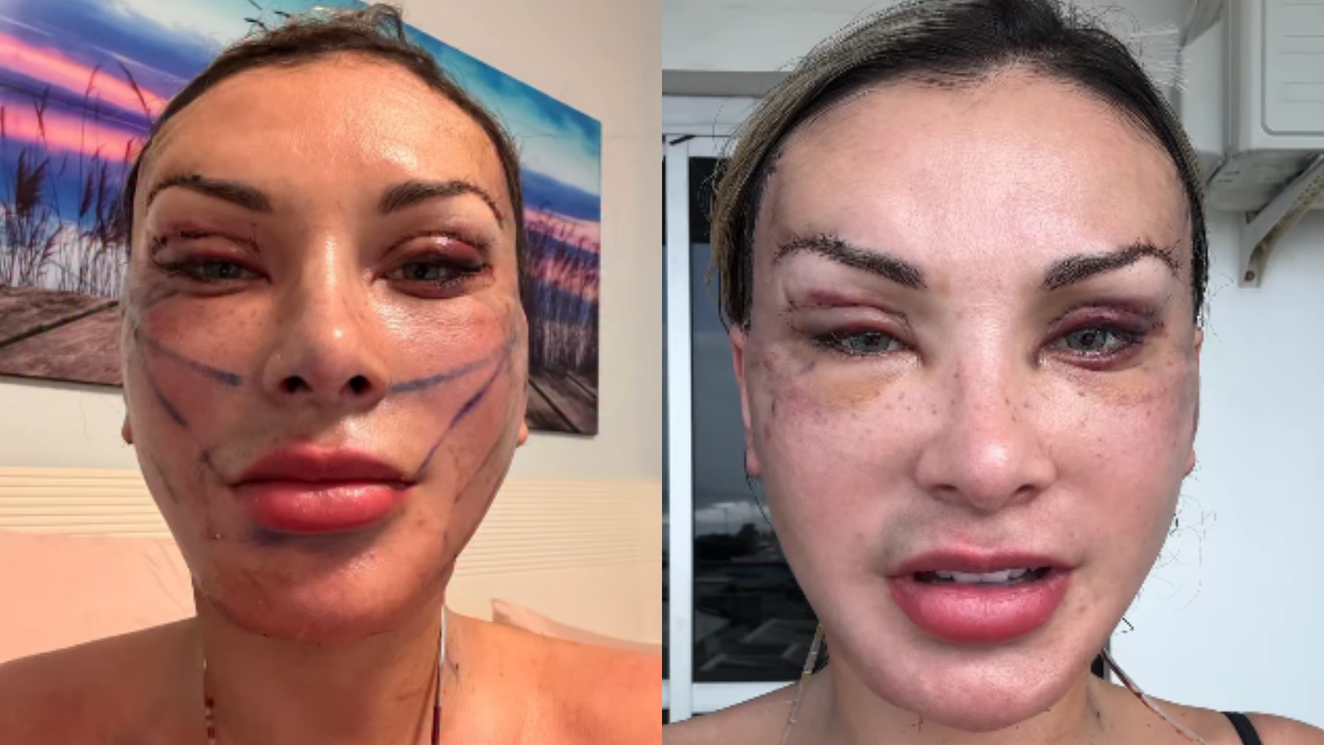 Andressa Urach detalha planos para novo procedimento estético e revela sonho pessoal