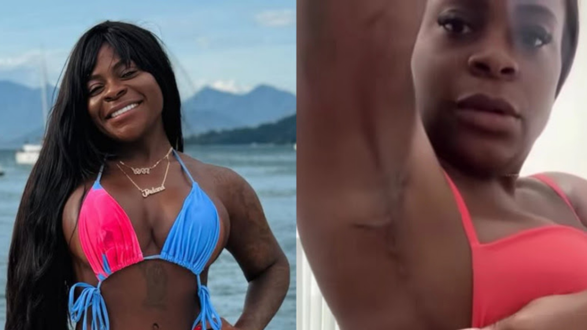 Cicatrizes de Jojo Todynho geram repercussão sobre recuperação de cirurgias plásticas
