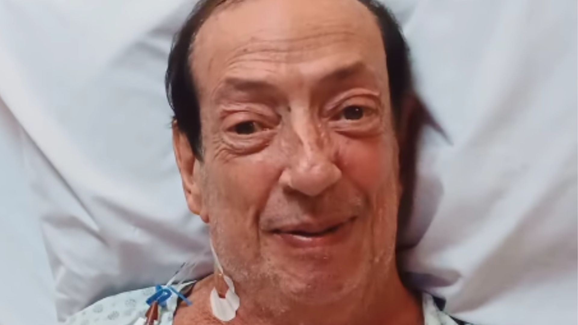 Marcos Oliveira, o eterno Beiçola, apresenta melhora após procedimento cirúrgico