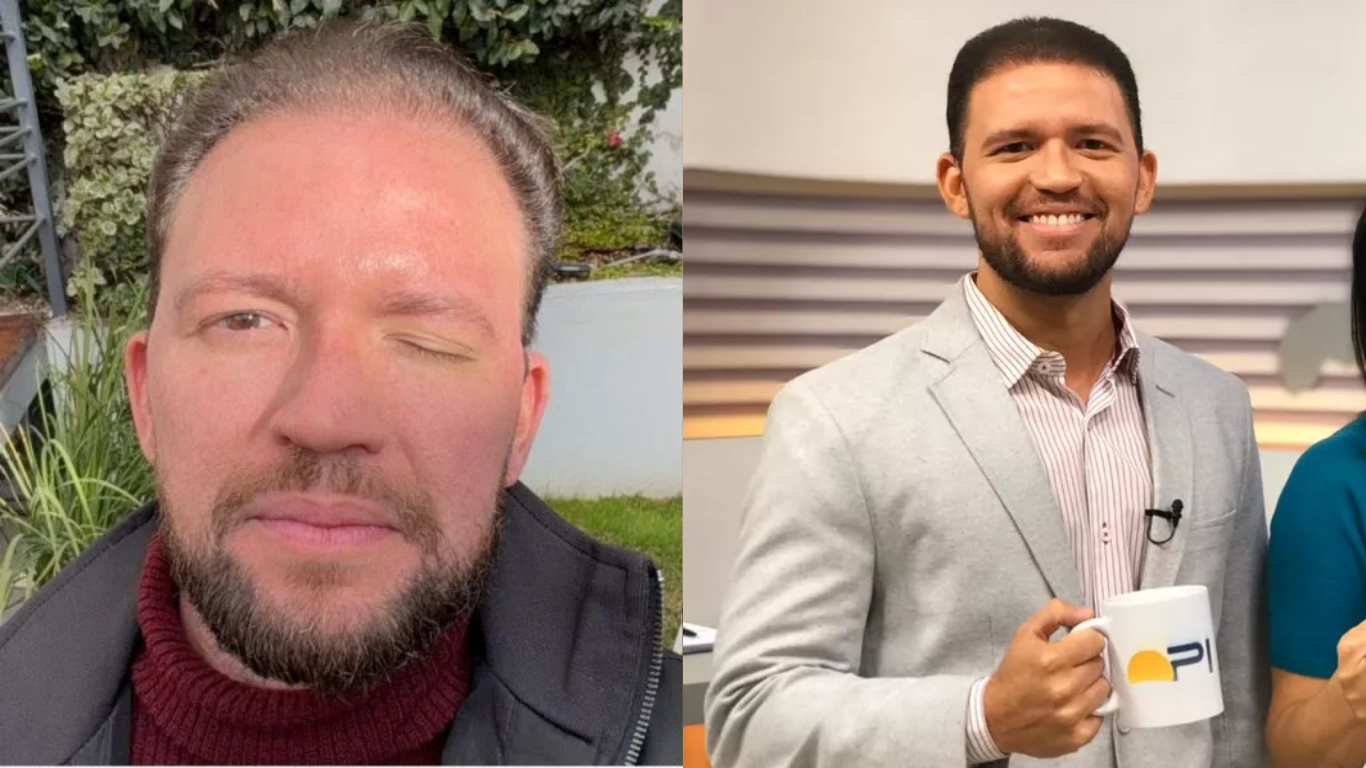 Apresentador do Piauí relata drama com botox e alerta sobre riscos de procedimentos estéticos